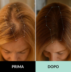 Sistema di microinfusione multi-peptidica  e adenosina per la caduta dei capelli