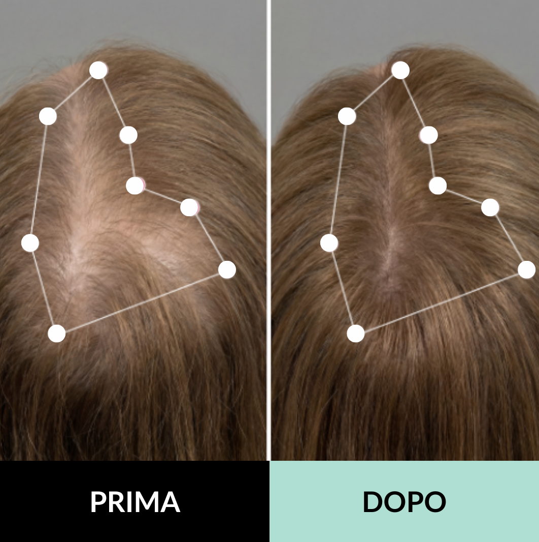 Sistema di microinfusione multi-peptidica  e adenosina per la caduta dei capelli