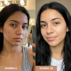 Stick Clinico per Cicatrici da Acne™