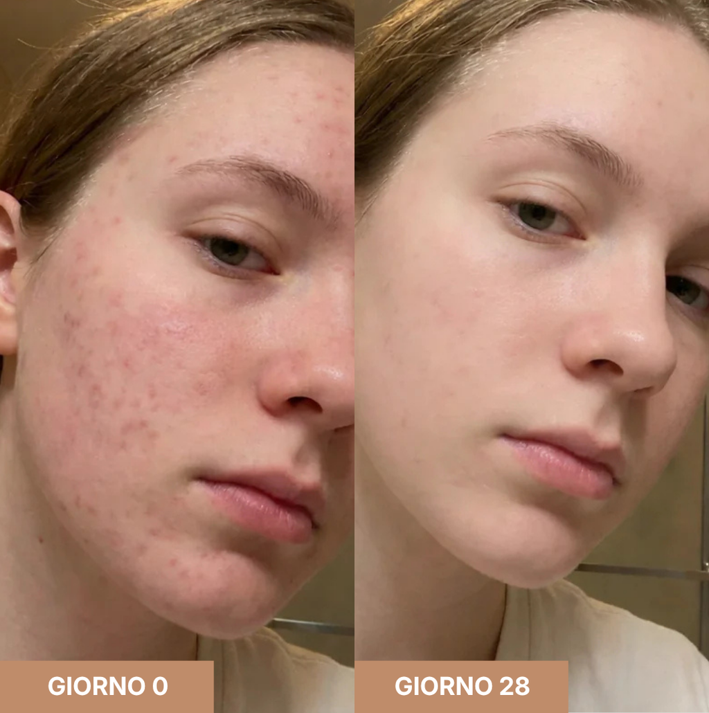 Stick Clinico per Cicatrici da Acne™