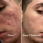 Stick Clinico per il Rimodellamento delle Cicatrici da Acne™